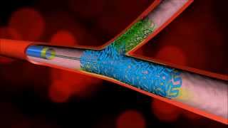 Dedicated Bifurcating Stent by Advanced Bifurcation Systems [upl. by Divad]