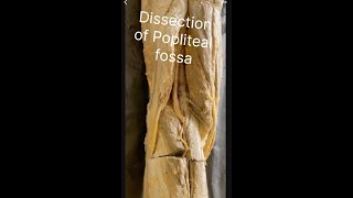 Popliteal fossa Dissection of popliteal fossa Anatomy of popliteal fossa Contents popliteal fossa [upl. by Lilia]