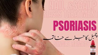 Cure Psoriasis Permanently With ONE Homeopathic Medicine Skin Scalp Nail Psoriasis [upl. by Tranquada594]