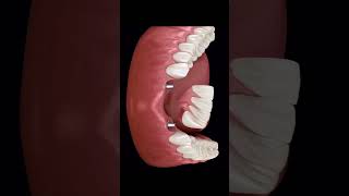 Implant supported removable partial denture RPD [upl. by Aihsas]