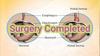 My Experience with Hiatal Hernia Repair and Nissan Fundoplication [upl. by Rintoul968]