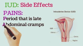 Intrauterine Device IUD Side Effects [upl. by Mcgaw723]