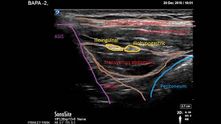 Ilioinguinal Iliohypogastric scanning [upl. by Ardnuassac843]