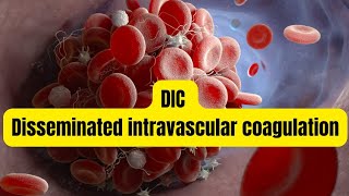 DIC Disseminated intravascular coagulation [upl. by Pavlish135]