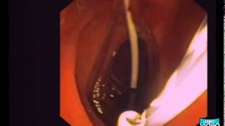 OvertheWire Stent Exchange Using a Simple Snare Technique in ERCP [upl. by Cissiee933]