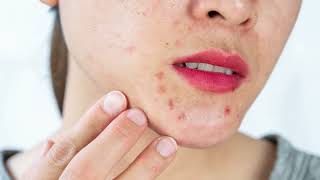 Uncover the Truth Behind Skin Spots Petechiae [upl. by Myrwyn]