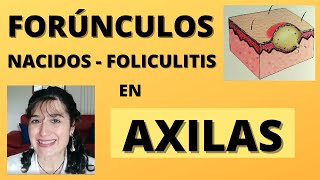 ¿Te salen GRANOS ROJOS ABAJO DEL BRAZO FOLICULITIS en AXILAS NACIDOS y FORÚNCULOS [upl. by Eniarral]