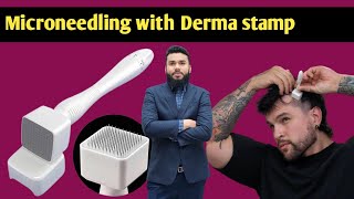 microneedling derma stamp derma roller hair regrowth  hair loss treatment  how to use derma Roler [upl. by Zimmerman910]