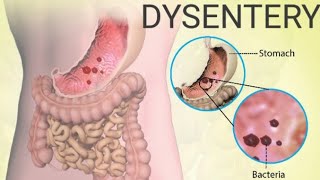 What is Dysentery Bacillary dysentery Amoebic dysentery DysenterysymptomsDiagnosis Treatment [upl. by Mccready72]