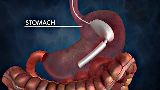 The Possible Dangers of Gastric Balloons for Weight Loss [upl. by Dwinnell790]