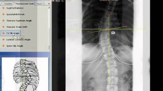 TraumaCad  T1 Tilt Angle [upl. by Renraw]