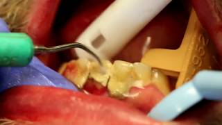 20 Years of Dental Calculus Removed with Ultrasonic and IV Sedation [upl. by Sophey]