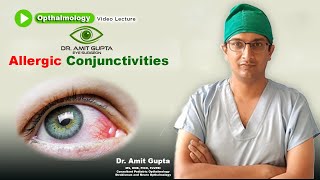 Allergic conjunctivitis  Ophthalmology  Signs and Symptoms  Diagnosis and Treatment [upl. by Ecirtahs517]