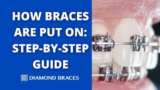 How Braces Are Put On StepbyStep with Dr Drut  Diamond Braces [upl. by Geraint]