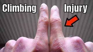 How I Injured My Finger Climbing  Recovery Strategy [upl. by Cartie242]