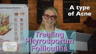 Treat Pityrosporum Folliculitis Dermatologists Tips 2019 [upl. by Alix]