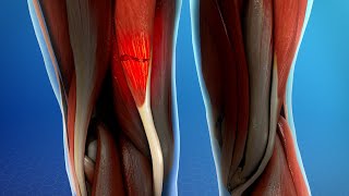 Hamstring Muscle Injuries [upl. by Araiet]