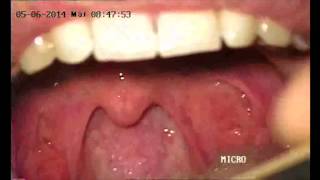 Exploración de la orofaringe  Oropharynx examination [upl. by Yorel]