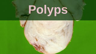 What are Polyps  Pathology mini tutorial [upl. by Aimek529]