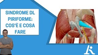 Sindrome del piriforme cosè e come si cura [upl. by Aggy]