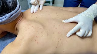 ACNE TREATMENT VU QUYNH MI Blackheads On Boy Back 2024 [upl. by Carlyle]