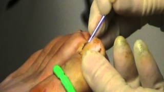 Phenol Matrixectomy Partial Toe Nail Removal [upl. by Anoyi997]