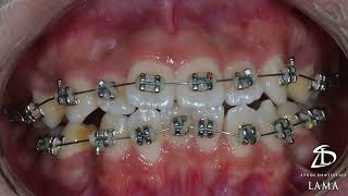 Braces time lapse [upl. by Yrrol]