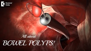 BOWEL POLYPS  How long does it take for a POLYP TO TURN INTO CANCERDrRavindra BSDoctors Circle [upl. by Norina]