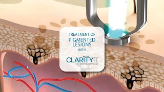 PIGMENTED LESIONS WITH CLARITY II LASER PLATFORM AVISSA SKIN [upl. by Oliva]