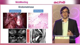 AULA 1 DIAGNÓSTICO E TRATAMENTO DE ENDOMETRIOSE [upl. by Drofub]