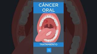 Cáncer oral Tratamiento  Kenhub canceroral [upl. by Bein926]