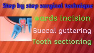 Impacted wisdom teeth part2 [upl. by Vasileior]