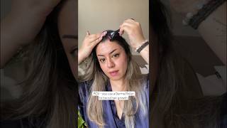 Derma Roller hair growth results are amazing Hair regrowth journey with derma roller 05 haircare [upl. by Zigmund]