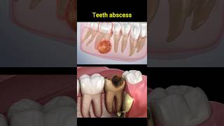 Tooth abscess problem dentist dentisty teeth dental [upl. by Boice]