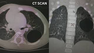 CPAM Congenital Pulmonary Airway Malformation [upl. by Leach430]