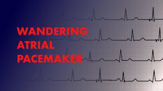 Wandering Atrial Pacemaker  EKG ECG Interpretation [upl. by Reckford151]