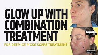 GLOW UP WITH COMBINATION TREATMENT FOR DEEP ICE PICKS SCARS TREATMENT  Dr Jason Emer [upl. by Axe]