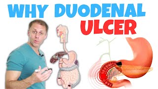 Understanding a Duodenal Ulcer [upl. by Anilahs]