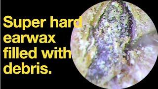 Super hard earwax filled with debris ear wax removal  ear cleaning  ASMR  relaxation  relax [upl. by Reine]