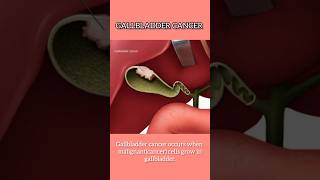 Gall bladder Cancer I Treatment for Gall bladder cancer in Delhi [upl. by Werdna]