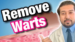 Wart Removal 101  How to Get Rid of Warts [upl. by Oicirbaf960]