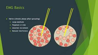 Neuropathy vs myopathy on EMG [upl. by Arrait514]