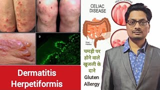 Dermatitis Herpetiformis  Celiac Disease  चमड़ी पर होने वाले खुजली के दाने  Gluten Allergy itch [upl. by Maclay]