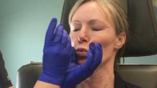 Botox in the neck for a smoother tighter look [upl. by Lauro]