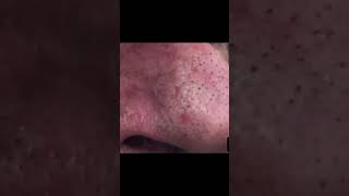 Need more of this Full 50 minutes blackheads extravaganza tagged here drpimplepopper [upl. by Laen226]