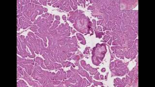 Histopathology Thyroid Papillary carcinoma [upl. by Eads]