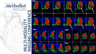 Nuclear Cardiology Understanding the Basics John J Mahmarian MD September 14 2021 [upl. by Danczyk422]