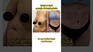 Înainte și după operație de Abdominoplastie  exces de piele abdomen  La Doctor Levy România [upl. by Raquel289]