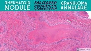 Rheumatoid Nodule amp Granuloma Annulare Palisaded Necrobiotic Granuloma Pattern Dermatopathology [upl. by Eletnahs841]