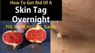 How To Get Rid Of A Skin Tag Overnight Using Fig Stem Juice amp Garlic [upl. by Ademordna]